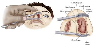 Nasal Speculum